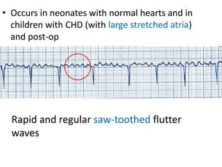 • Occurs in neonates with normal hearts and in
children with CHD (with large stretched atria)
and post-op
Rapid and regular saw-toothed flutter
waves
 