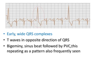 • Early, wide QRS complexes
• T waves in opposite direction of QRS
• Bigeminy, sinus beat followed by PVC,this
repeating as a pattern also frequently seen
 