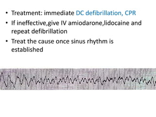 • Treatment: immediate DC defibrillation, CPR
• If ineffective,give IV amiodarone,lidocaine and
repeat defibrillation
• Treat the cause once sinus rhythm is
established
 
