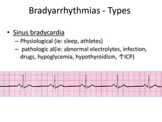Bradyarrhythmias - Types
• Sinus bradycardia
– Physiological (ie: sleep, athletes)
– pathologic al(ie: abnormal electrolytes, infection,
drugs, hypoglycemia, hypothyroidism, ↑ICP)
 