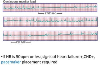 •If HR is 50bpm or less,signs of heart failure +,CHD+,
pacemaker placement required
 