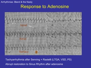 Arrhythmias – clinical features | PPT