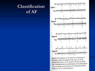 Arrhythmias general | PPT