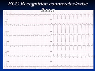 Arrhythmias general | PPT