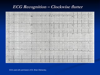 Arrhythmias general | PPT