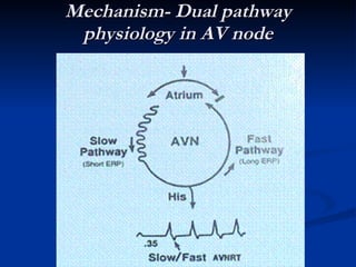 Arrhythmias general | PPT