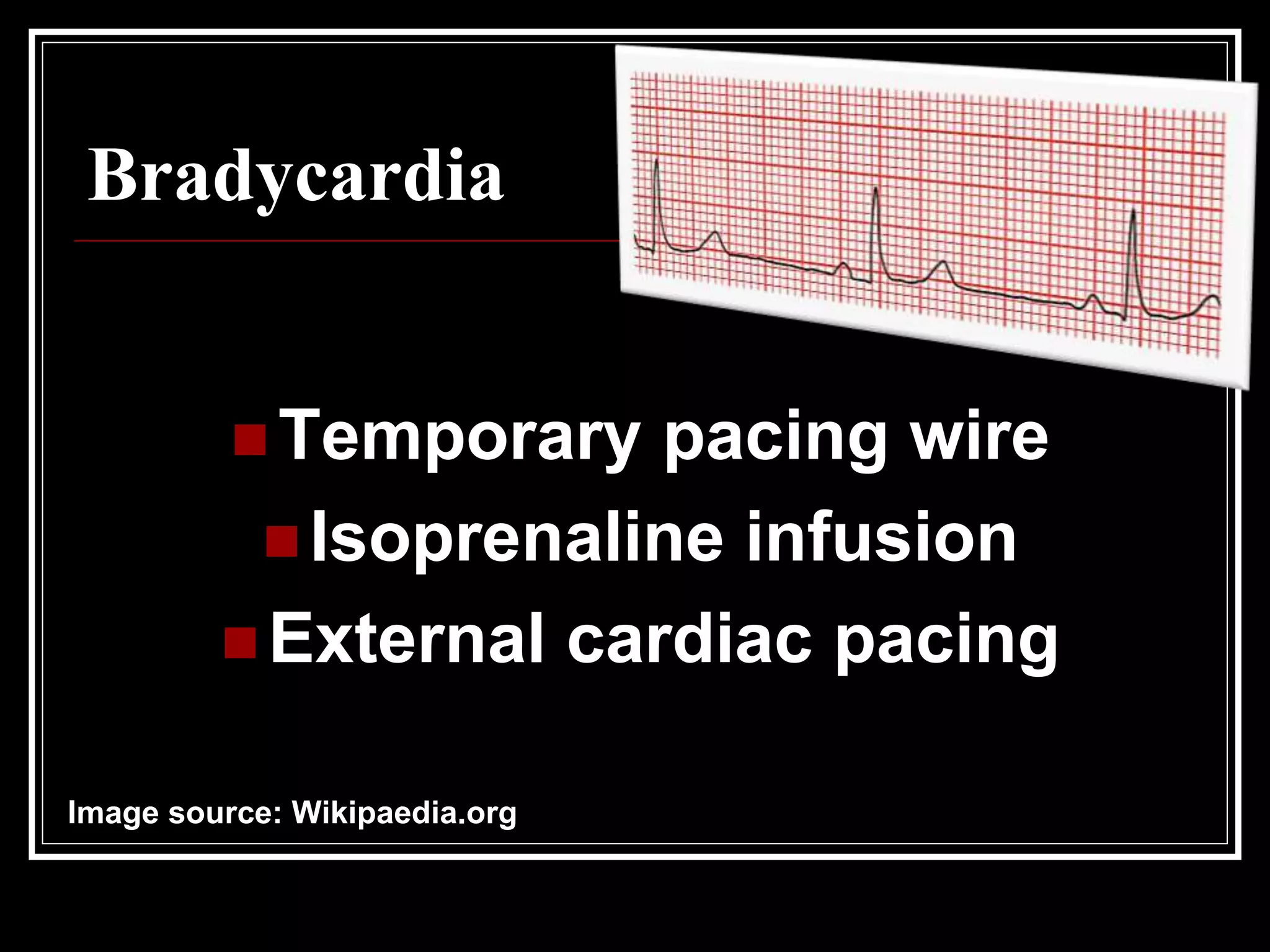 Bradycardia
 Temporary pacing wire
 Isoprenaline infusion
 External cardiac pacing
Image source: Wikipaedia.org
 