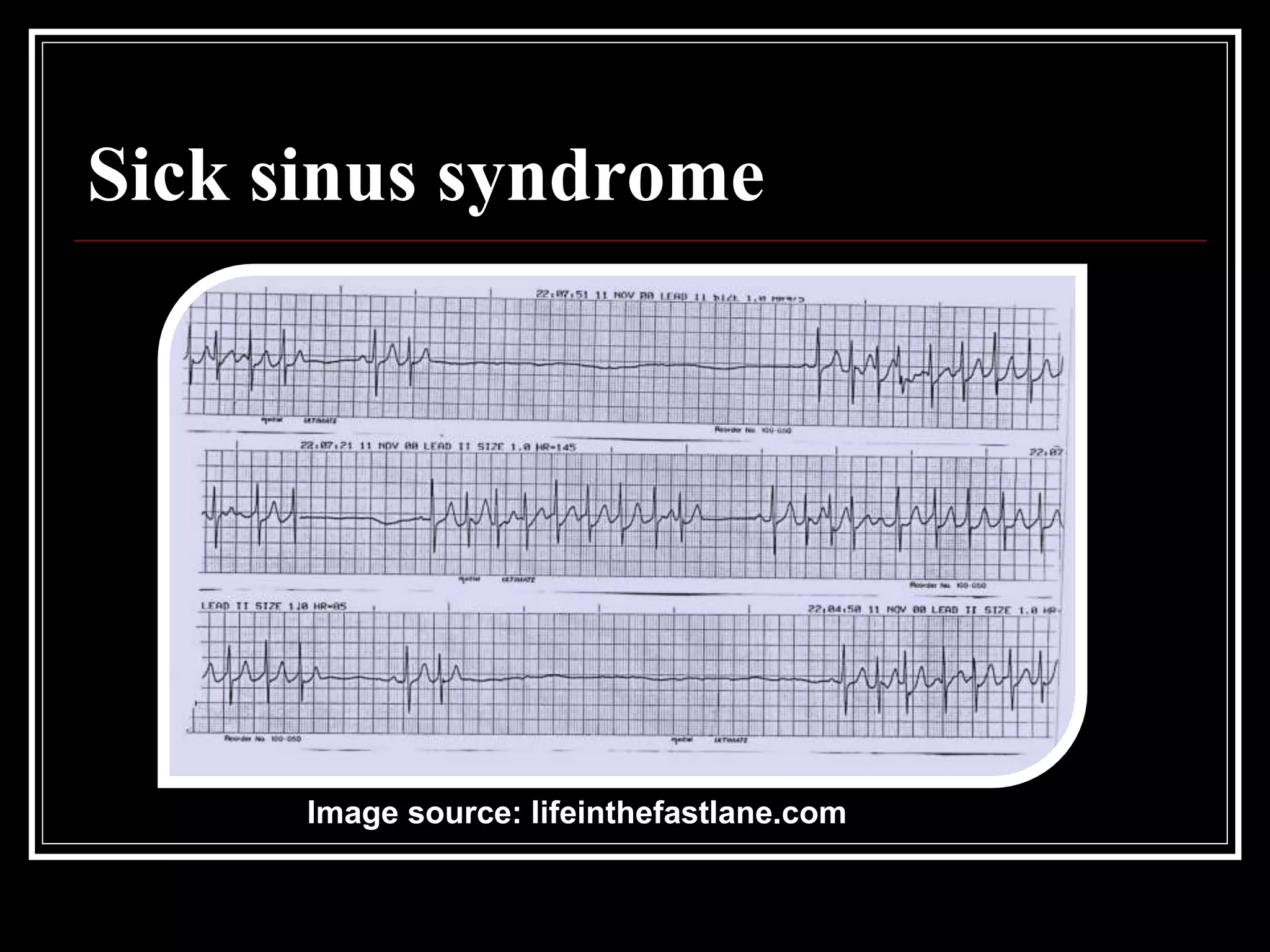 Sick sinus syndrome
Image source: lifeinthefastlane.com
 