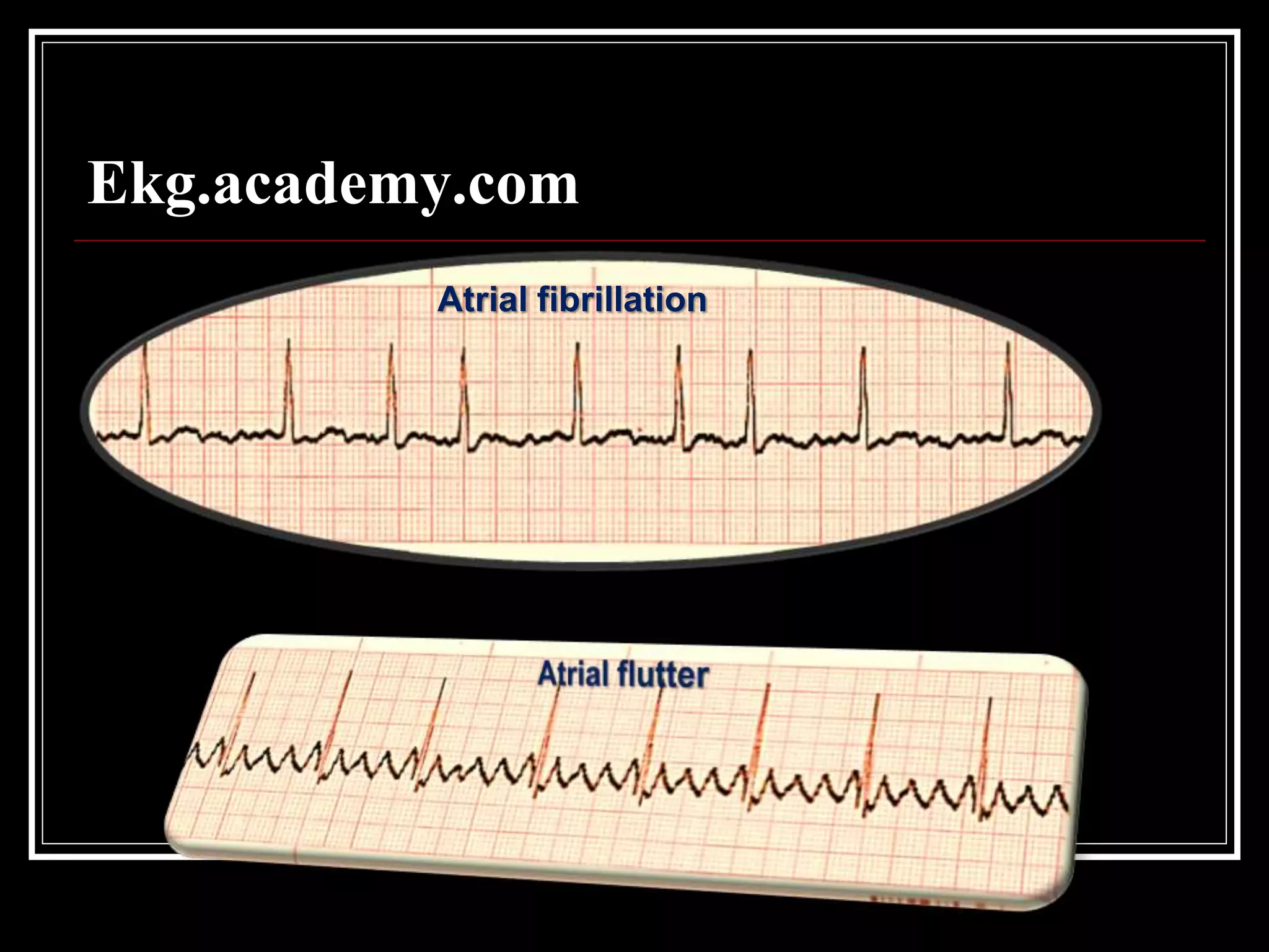 Ekg.academy.com
Atrial fibrillation
 