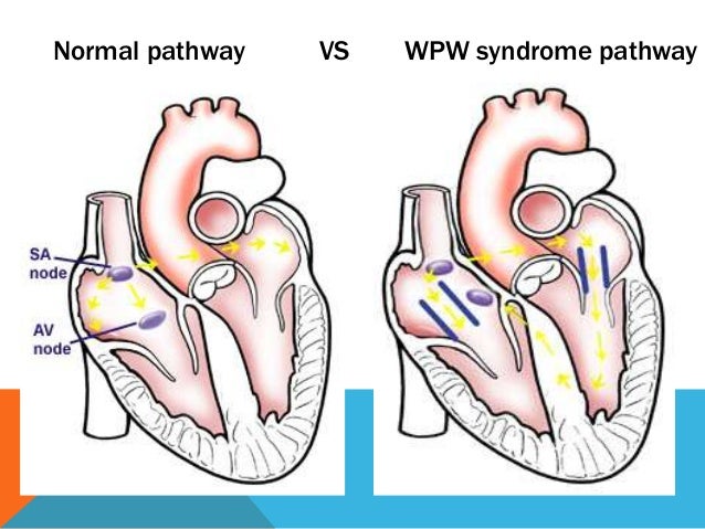 Heart Disease Wpw Syndrome Cardiovascular Disease