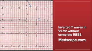 Inverted T waves in
V1-V2 without
complete RBBB
Medscape.com
Medscape.com
 