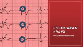 EPISLON WAVES
in V1-V3
https://lifeinthefastlane.com
 