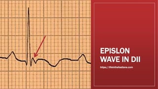 EPISLON
WAVE IN DII
https://lifeinthefastlane.com
 