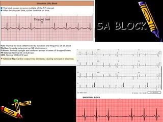 SA BLOCKSA BLOCK
Rate normal or bradycardia
P wave those present are normal
QRS normal
Conduction normal
Rhythm basic rhythm is regular*
 