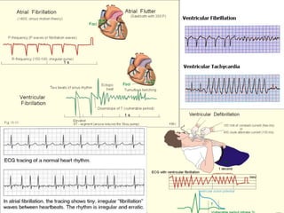 Potassium
 Hyperkalemia:
Increases rate of repolarization, resulting in
sharp-spiked T waves
 Shortened QT interval.
 Hypokalemia:
Decreases rate of repolarization, resulting in
U waves
 Prolonged QT interval.
Calcium
 Hypercalcemia:
Decreases the QT interval
 Hypocalcemia:
Increases the QT interval
 