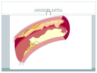 ANGIOPLASTIA 