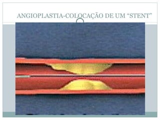 ANGIOPLASTIA-COLOCAÇÃO DE UM “STENT” 