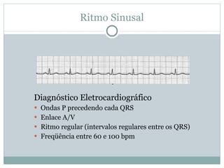 Ritmo Sinusal Diagnóstico Eletrocardiográfico Ondas P precedendo cada QRS Enlace A/V Ritmo regular (intervalos regulares entre os QRS) Freqüência entre 60 e 100 bpm ° 