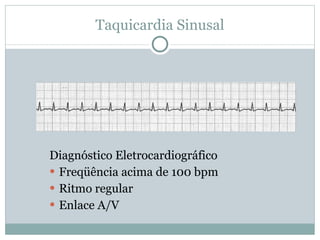Taquicardia Sinusal Diagnóstico Eletrocardiográfico Freqüência acima de 100 bpm Ritmo regular Enlace A/V 