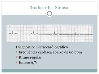 Bradicardia  Sinusal Diagnóstico Eletrocardiográfico Freqüência cardíaca abaixo de 60 bpm Ritmo regular Enlace A/V 
