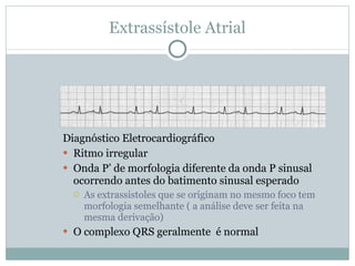Extrassístole Atrial Diagnóstico Eletrocardiográfico Ritmo irregular Onda P’ de morfologia diferente da onda P sinusal ocorrendo antes do batimento sinusal esperado As extrassistoles que se originam no mesmo foco tem morfologia semelhante ( a análise deve ser feita na mesma derivação) O complexo QRS geralmente  é normal 