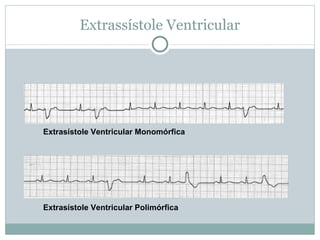 Extrassístole Ventricular Extrasístole Ventricular Monomórfica Extrasístole Ventricular Polimórfica 