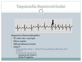 Taquicardia Supraventricular Diagnóstico Eletrocardiográfico FC entre 160 e 240 bpm Ritmo regular QRS geralmente normal Onda P Taquicardia Atrial – Onda P de morfologia diferente da P sinusal Taquicardia juncional Ausência de Onda P Onda P negativa    