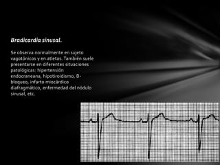 Bradicardia sinusal.
Se observa normalmente en sujeto
vagotónicos y en atletas. También suele
presentarse en diferentes situaciones
patológicas: hipertensión
endocraneana, hipotiroidismo, B-
bloqueo, infarto miocárdico
diafragmático, enfermedad del nódulo
sinusal, etc.
 
