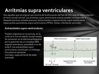 Arritmias supra ventriculares
Son aquellas que se originan por encima de la bifurcación del haz de His y que se sobre imponen
al ritmo sinusal normal. Las arritmias supra ventriculares activas pueden corresponder a
despolarizaciones aisladas precoces (extrasístoles) o taquiarritmias supra ventriculares
(taquicardias paroxísticas supra ventriculares (TPSV), flutter y fibrilación auricular).

 Extrasístoles supra ventriculares.
 Pueden originarse en la aurícula, en la
 unión A-V o en el nódulo sinusal mismo.
 Se reconocen en el electrocardiograma
 por la aparición de un complejo QRS
 angosto prematuro, precedido o no de
 onda P. Las extrasístoles supra
 ventriculares constituyen un hallazgo
 frecuente en personas
 normales, especialmente de edad
 avanzada
 