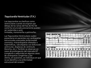 Taquicardia Ventricular (T.V.)
Las taquicardias se clasifican como
ventriculares cuando se originan por
debajo de las ramas del haz de His Tal
como fue enunciado previamente pueden
ser sostenidas o auto
limitadas, monomorfas o polimorfas.
Las Taquicardias Ventriculares suelen
presentarse en pacientes con cardiopatías
estructurales avanzadas (enfermedad
coronaria, miocardiopatías dilatadas o
hipertróficas, valvulópatias con disfunción
ventricular, displasias de ventrículo
Derecho, etc.). También se observan en
casos de prolongación del intervalo QT
(congénito o adquirido) en algunos casos
de cardiopatías congénitas y por
último, en ocasiones, en individuos en que
no se identifica una enfermedad
estructural del corazón.
 