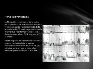Fibrilación ventricular.
La fibrilación ventricular se caracteriza
por la presencia de una actividad eléctrica
ventricular rápida y desorganizada. Esto
le confiere al ECG una imagen ondulatoria
de amplitud y contornos variables. No se
distinguen complejos QRS, segmento ST
ni ondas T.
Desde un punto de vista clínico determina
colapso cardiocirculatorio y daño
neurológico irreversible en plazo de 3 a 5
minutos, a menos que se tomen las
medidas que interrumpan la arritmia.
 