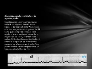 Bloqueos aurículo-ventriculares de
segundo grado.
En estos casos observaremos algunas
ondas P no seguidas de QRS. En los
bloqueos de tipo Mobitz I o Wenkebach
existe un alargamiento progresivo del PR
hasta que un impulso auricular no se
conduce, apareciendo una pausa. En la
mayoría de los casos, asientan en el
nódulo AV. En los bloqueos tipo Mobitz II
no existe progresión del intervalo PR
precediendo a la pausa ventricular. Son
prácticamente siempre expresión de un
trastorno distal al haz de His.
 