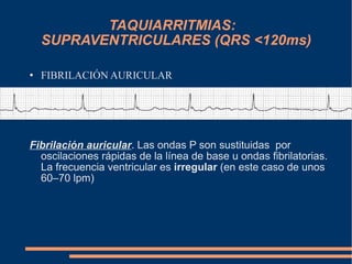TAQUIARRITMIAS:  SUPRAVENTRICULARES (QRS <120ms) FIBRILACIÓN AURICULAR Fibrilación auricular . Las ondas P son sustituidas  por oscilaciones rápidas de la línea de base u ondas fibrilatorias. La frecuencia ventricular es  irregular  (en este caso de unos 60 – 70 lpm)  