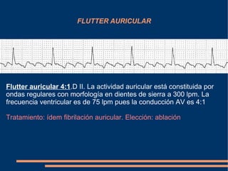 FLUTTER AURICULAR Flutter auricular 4:1 .D II. La actividad auricular está constituida por ondas regulares con morfología en dientes de sierra  a  300 lpm. La frecuencia ventricular es de 75 lpm pues la conducción AV es 4:1 Tratamiento: ídem fibrilación auricular. Elección: ablación  