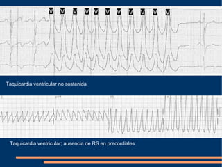 Taquicardia ventricular no sostenida Taquicardia ventricular; ausencia de RS en precordiales 