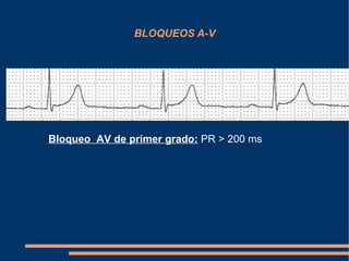 BLOQUEOS A-V Bloqueo  AV de primer grado:  PR > 200 ms  