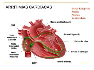 ARRITIMIAS CARDÍACAS                    Focos Ectópicos
                                        Atriais
                                        Nodais
                                        Ventriculares
                    Ramo de Bachmann
   NSA



  Trato                       Ramo Esquerdo
Internodal
 Anterior
                                          Feixe de Hiss
   Trato
 Internodal
   Médio

   Trato                            Direção da Condução
 Internodal
  Posterior

                         Ramo Direito
              NAV
 