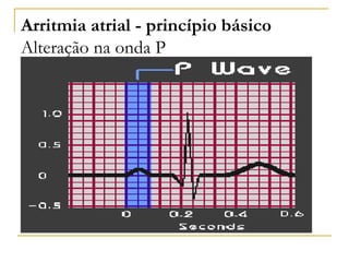 Arritmia atrial - princípio básico
Alteração na onda P
 
