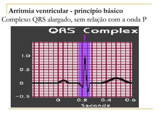 Arritmia ventricular - princípio básico
Complexo QRS alargado, sem relação com a onda P
 