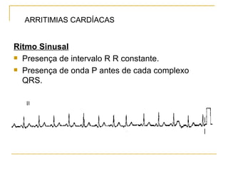 ARRITIMIAS CARDÍACAS


Ritmo Sinusal
 Presença de intervalo R R constante.

 Presença de onda P antes de cada complexo

  QRS.
 