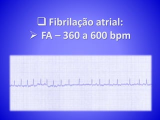  Fibrilação atrial:
 FA – 360 a 600 bpm
 