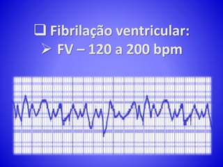  Fibrilação ventricular:
 FV – 120 a 200 bpm
 
