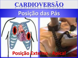 Posição das Pás
Posição Externo - Apical
 