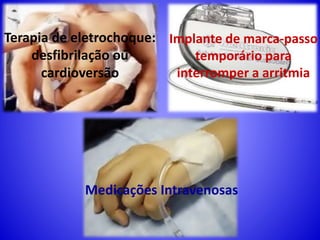 Implante de marca-passo
temporário para
interromper a arritmia
Terapia de eletrochoque:
desfibrilação ou
cardioversão
Medicações Intravenosas
 