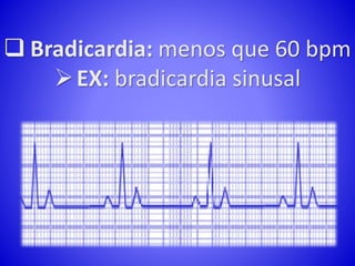  Bradicardia: menos que 60 bpm
EX: bradicardia sinusal
 
