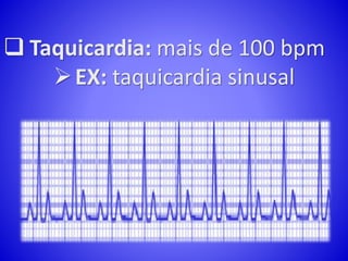  Taquicardia: mais de 100 bpm
EX: taquicardia sinusal
 