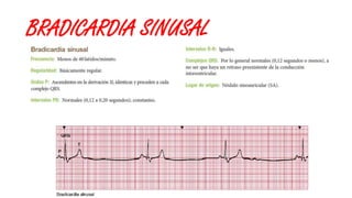 BRADICARDIA SINUSAL
 