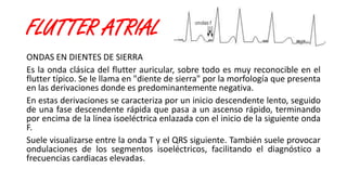 FLUTTER ATRIAL
ONDAS EN DIENTES DE SIERRA
Es la onda clásica del flutter auricular, sobre todo es muy reconocible en el
flutter típico. Se le llama en "diente de sierra" por la morfología que presenta
en las derivaciones donde es predominantemente negativa.
En estas derivaciones se caracteriza por un inicio descendente lento, seguido
de una fase descendente rápida que pasa a un ascenso rápido, terminando
por encima de la línea isoeléctrica enlazada con el inicio de la siguiente onda
F.
Suele visualizarse entre la onda T y el QRS siguiente. También suele provocar
ondulaciones de los segmentos isoeléctricos, facilitando el diagnóstico a
frecuencias cardiacas elevadas.
 