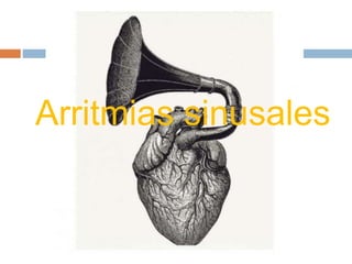 Arritmias sinusales
 