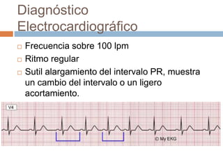 Diagnóstico
Electrocardiográfico
 Frecuencia sobre 100 lpm
 Ritmo regular
 Sutil alargamiento del intervalo PR, muestra
un cambio del intervalo o un ligero
acortamiento.
 